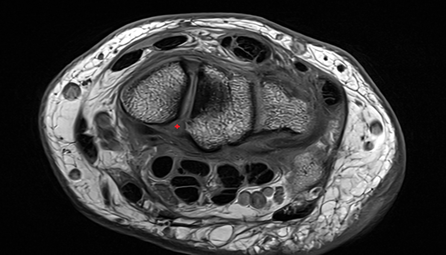 Volar scapholunate ligament  ligament axial cross sectional anatomy 3T MRI AI enhanced radiology image-img-00000-00000