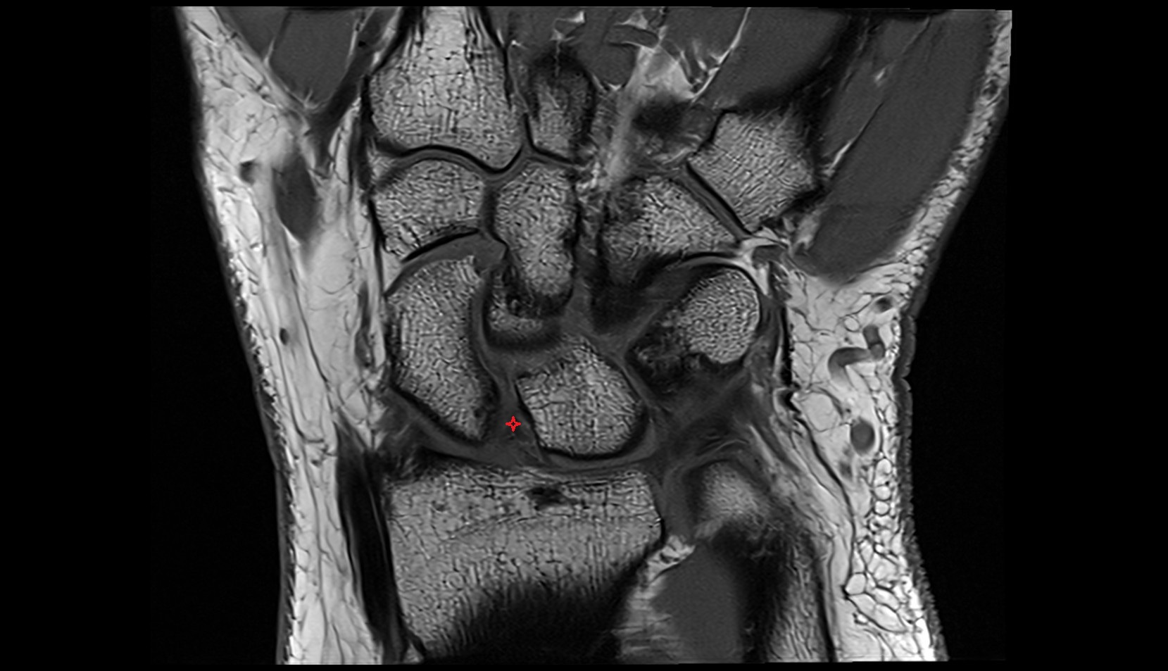 Volar scapholunate ligament mri coronal image