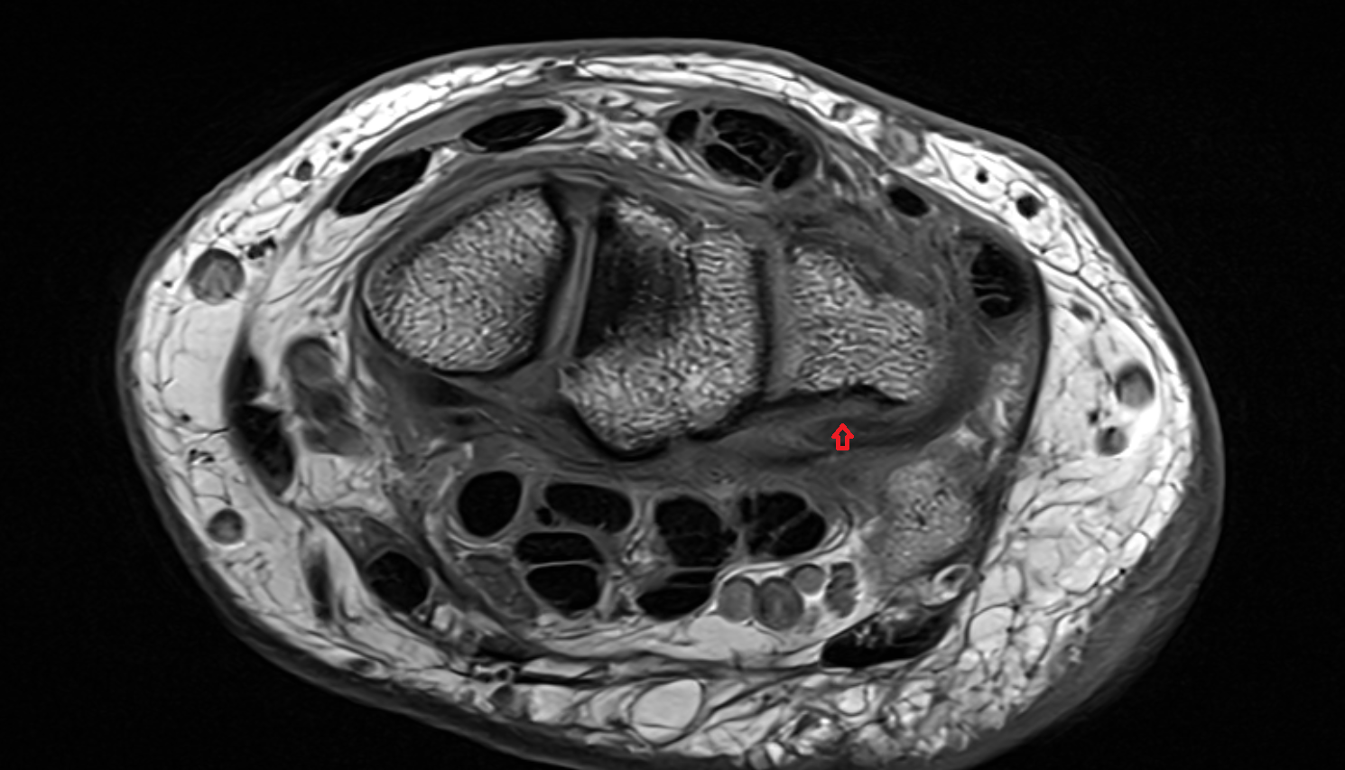 Volar ulnolunate ligament  axial cross sectional anatomy 3T MRI AI enhanced radiology image-img-00000-00000