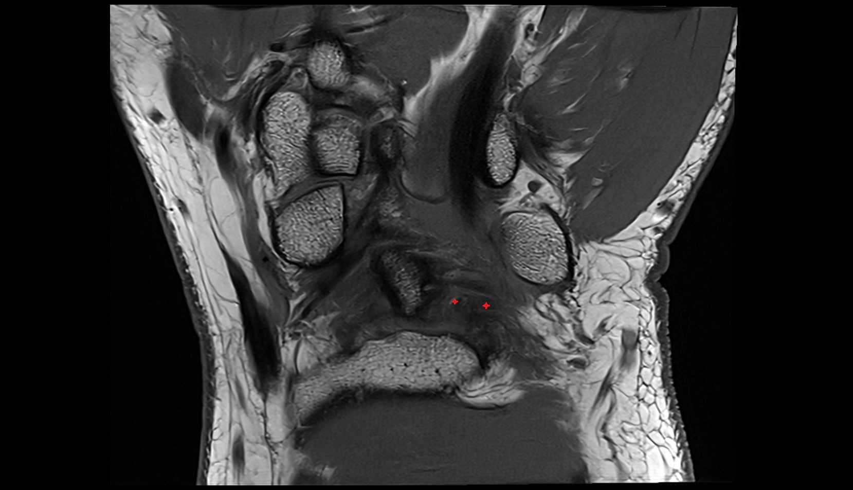Volar ulnolunate ligament coronal mri image