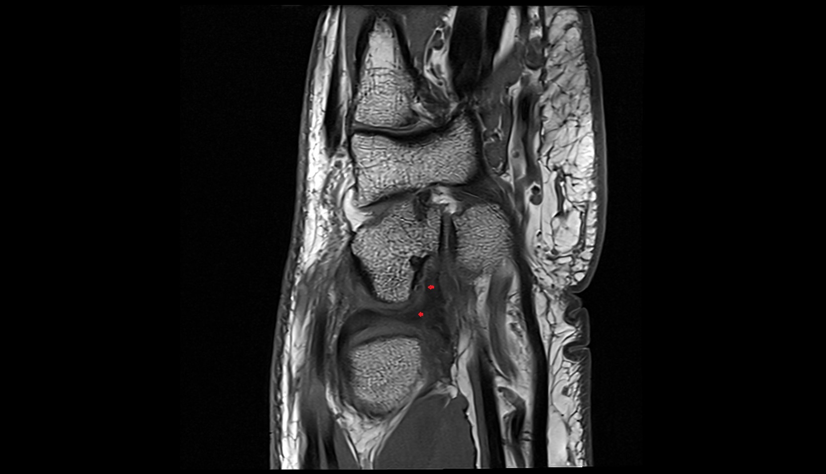 Volar ulnolunate ligament mri sag image