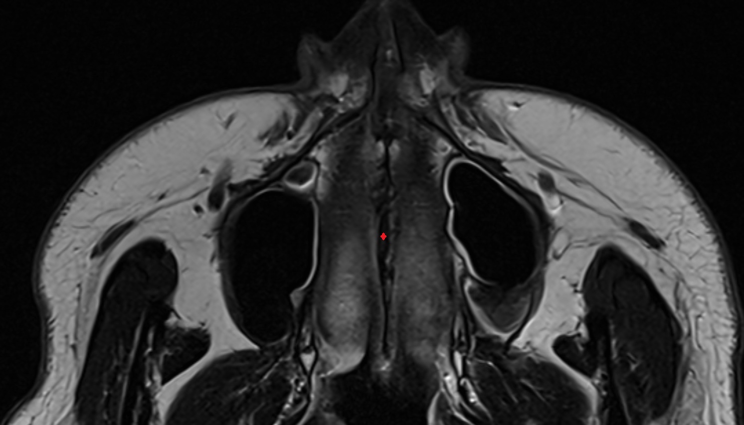 Vomer  mri axial image -img-00000-00000