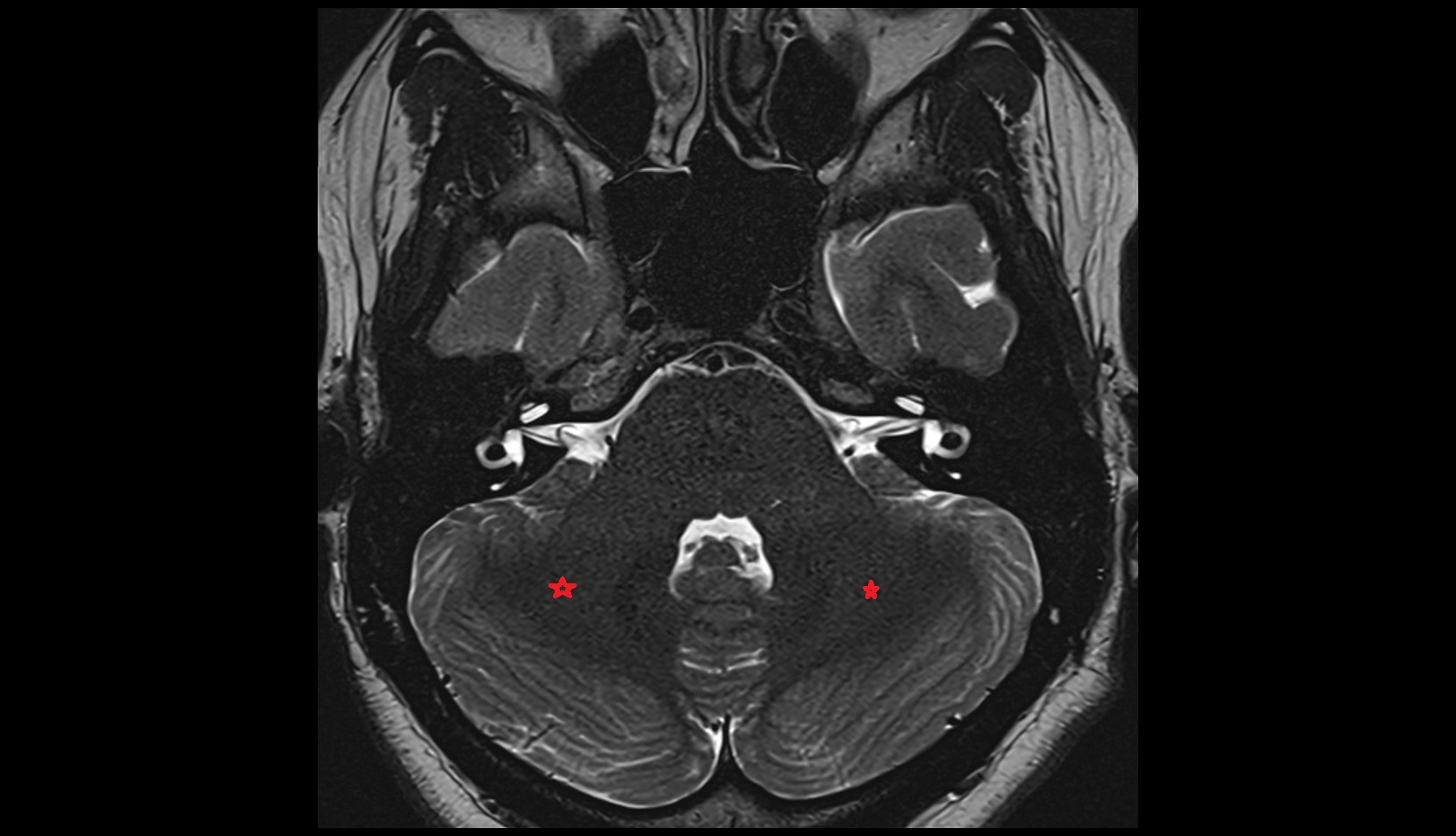 White matter of cerebellum (Arbor vitae)