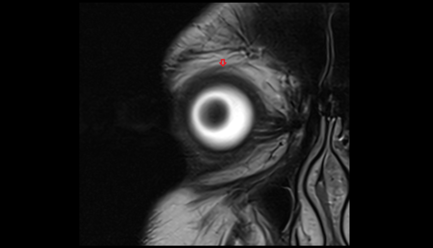 Whitnall's ligament mri image