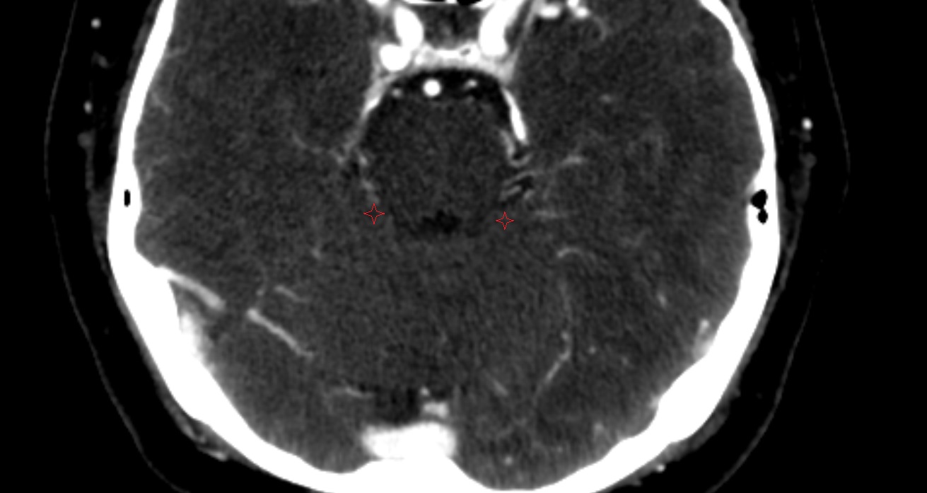 Wing of central lobule  CT axial anatomy image -img-00001-00001