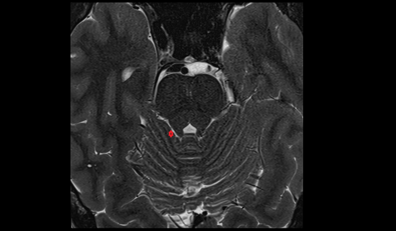 Wing of central lobule MRI 3T axial image