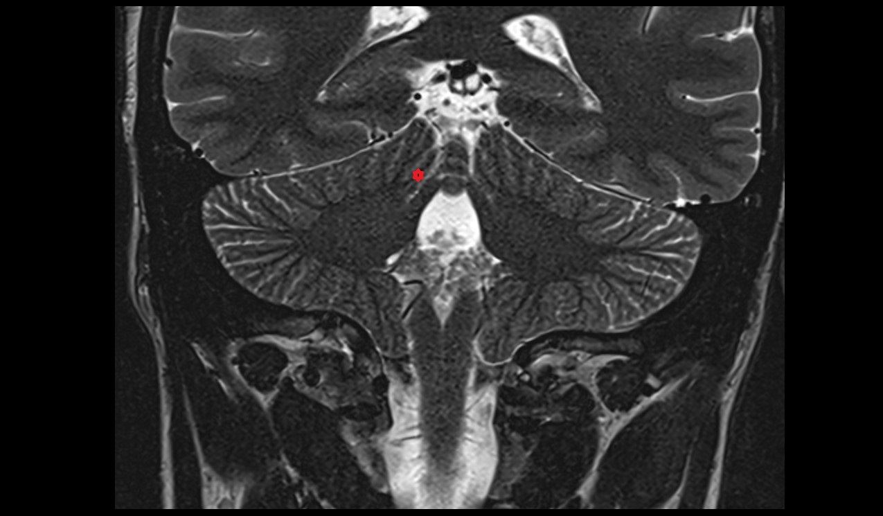 Wing of central lobule MRI 3T coronal image