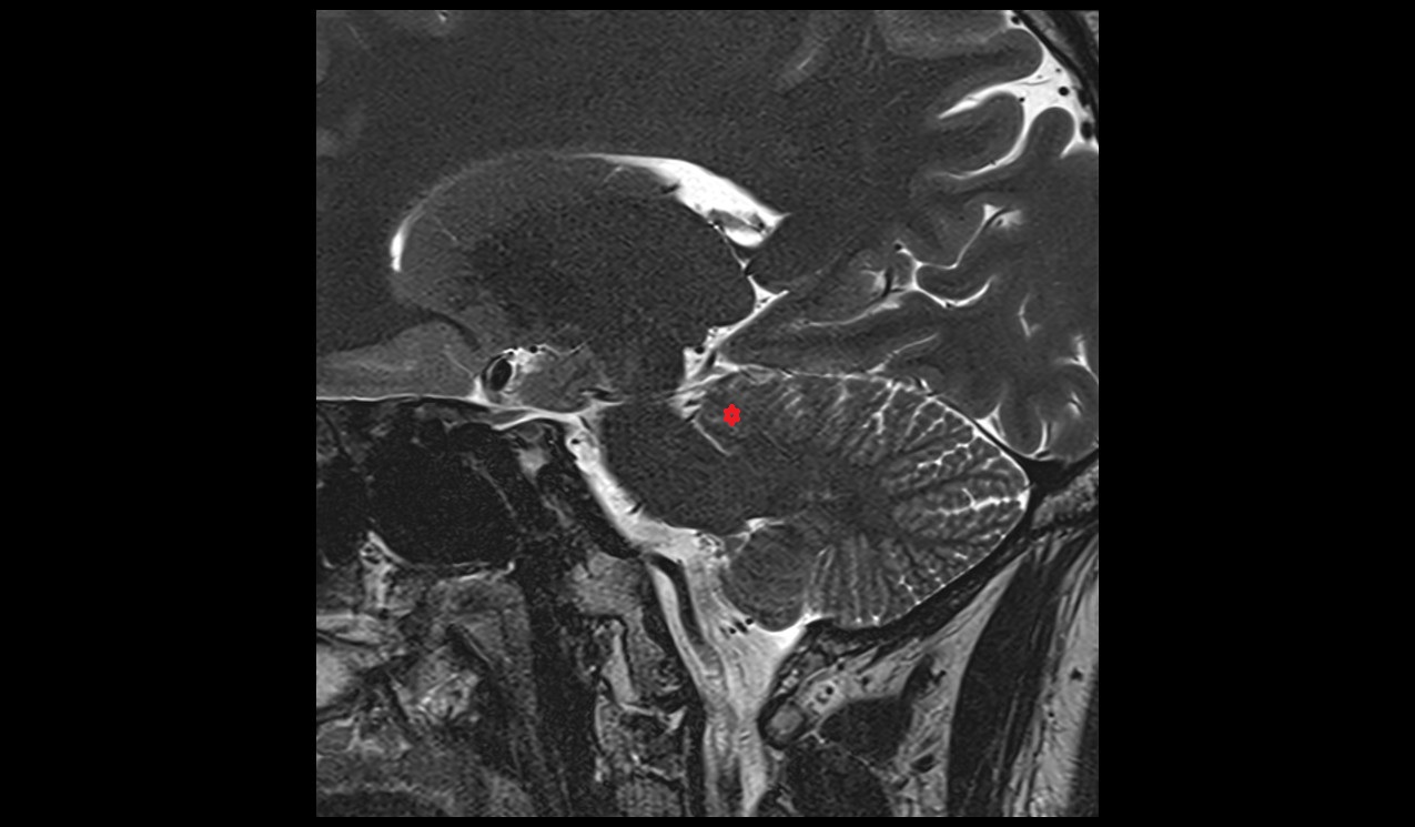 Wing of central lobule MRI 3T sagittal image