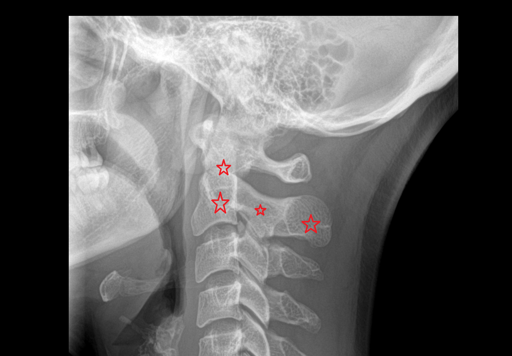X Ray C2 Vertebra (Axis)