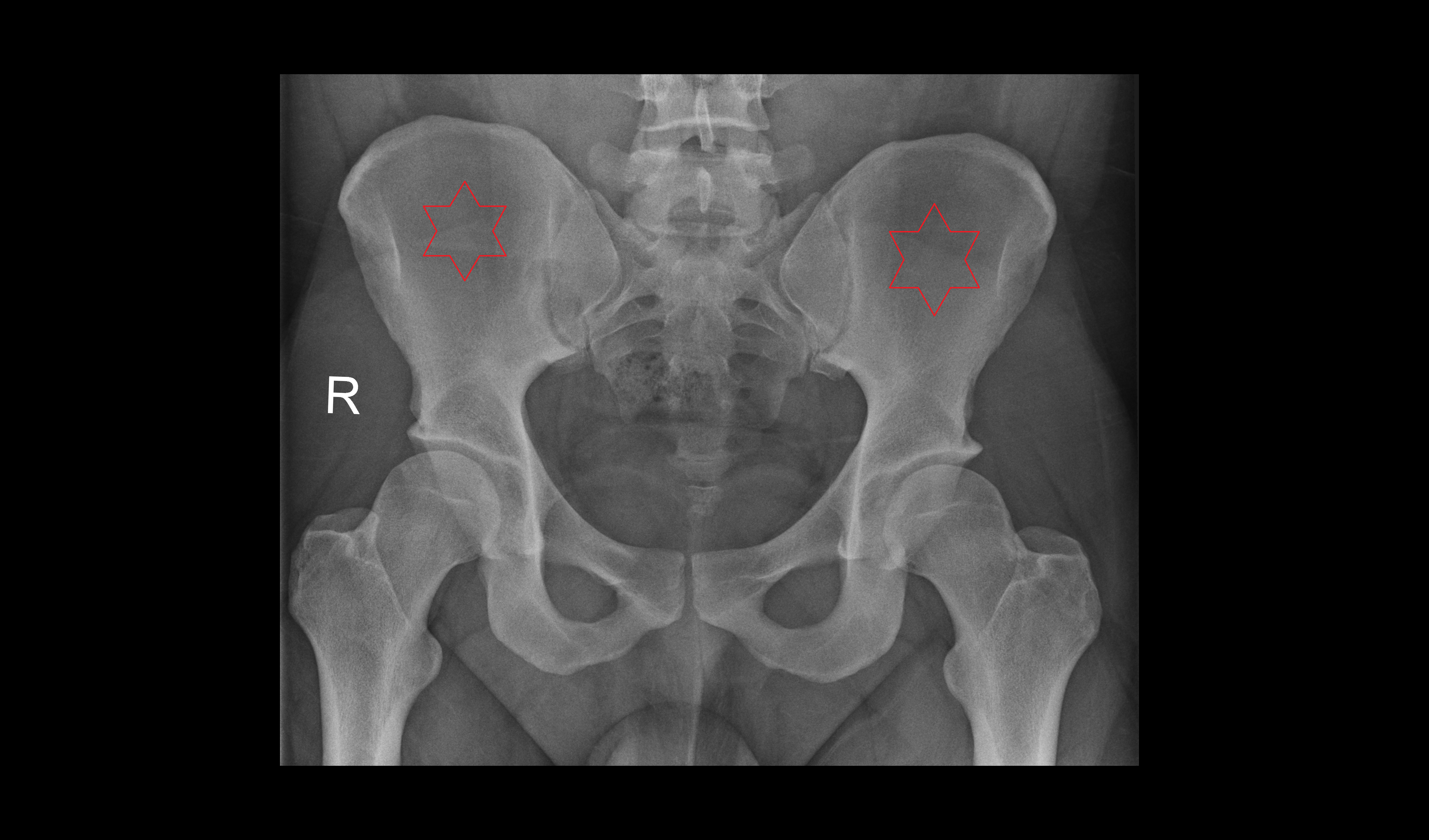 X Ray Iliac bone