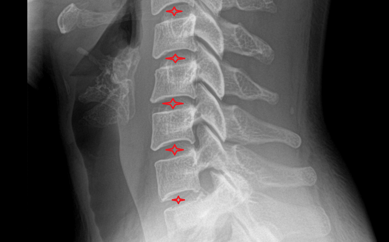 X Ray Intervertebral Disc Space