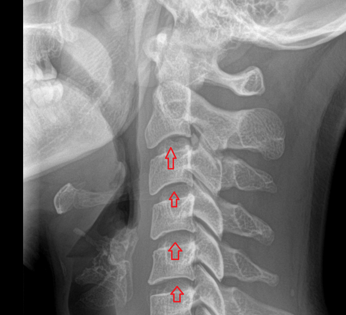 X Ray The uncinate process