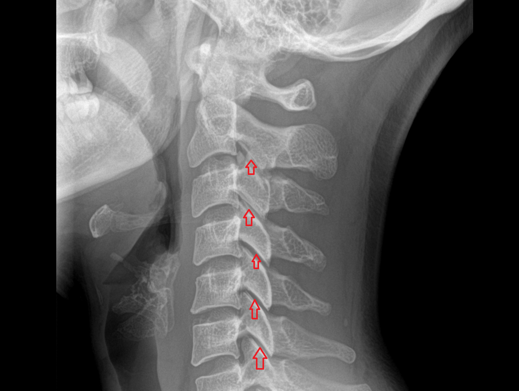 X Ray Zygapophyseal joint