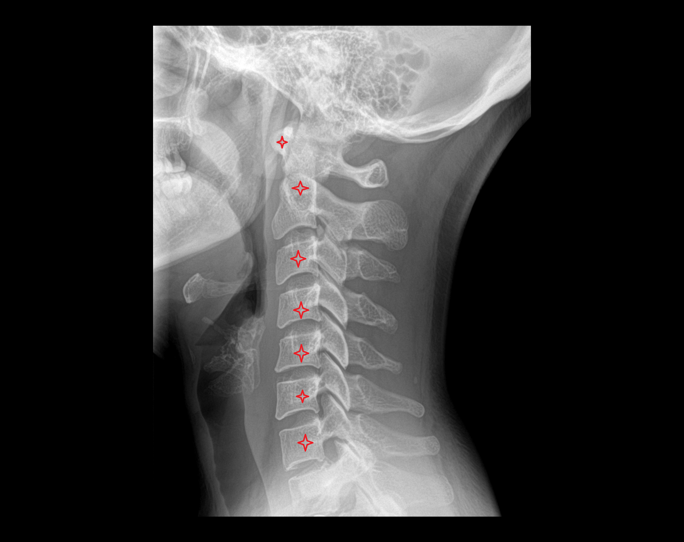 X Ray cervical spine