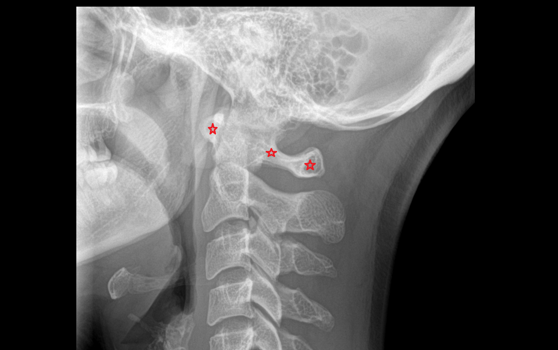 X Ray cervical spine lateral anatomy labelled -img-00000-00000 (1) - Copy