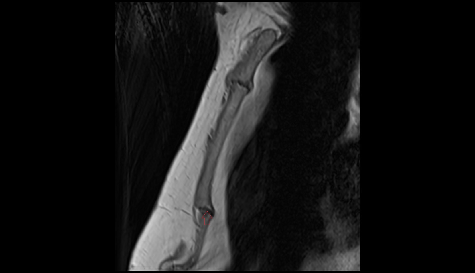 Xiphisternal joint MRI sagittal image