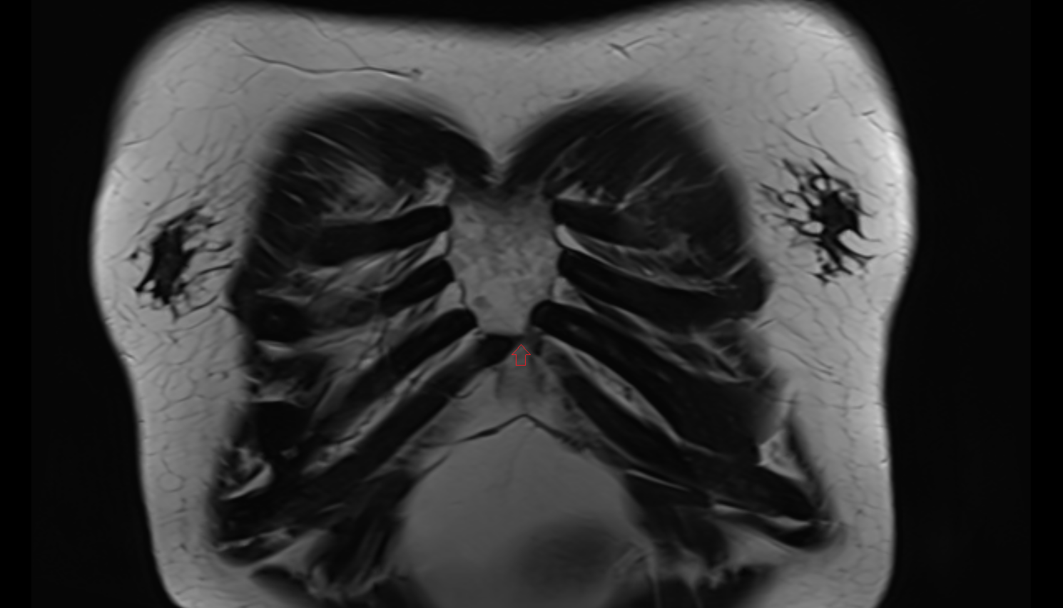 Xiphisternal joint coronal MRI  image-img-00000-00000