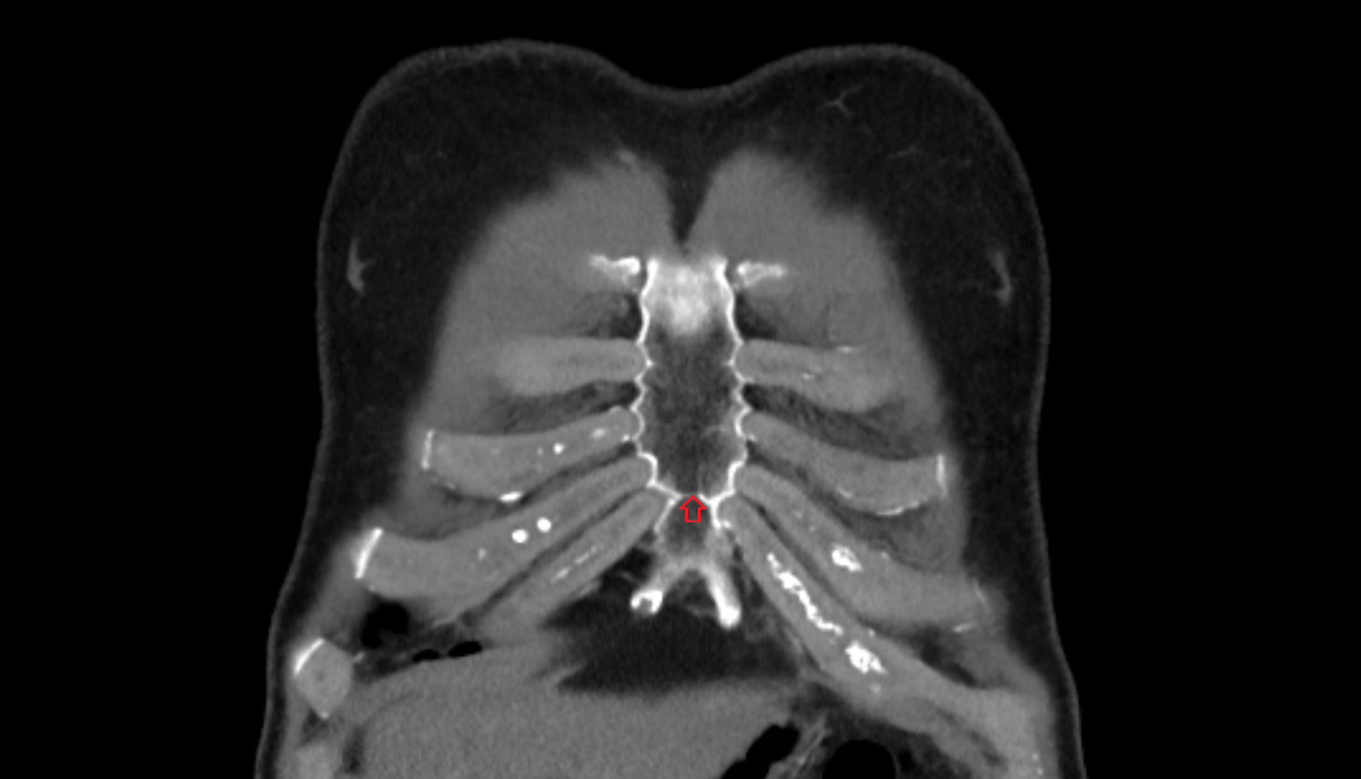 Xiphisternal joint coronal ct  image-img-00000-00000