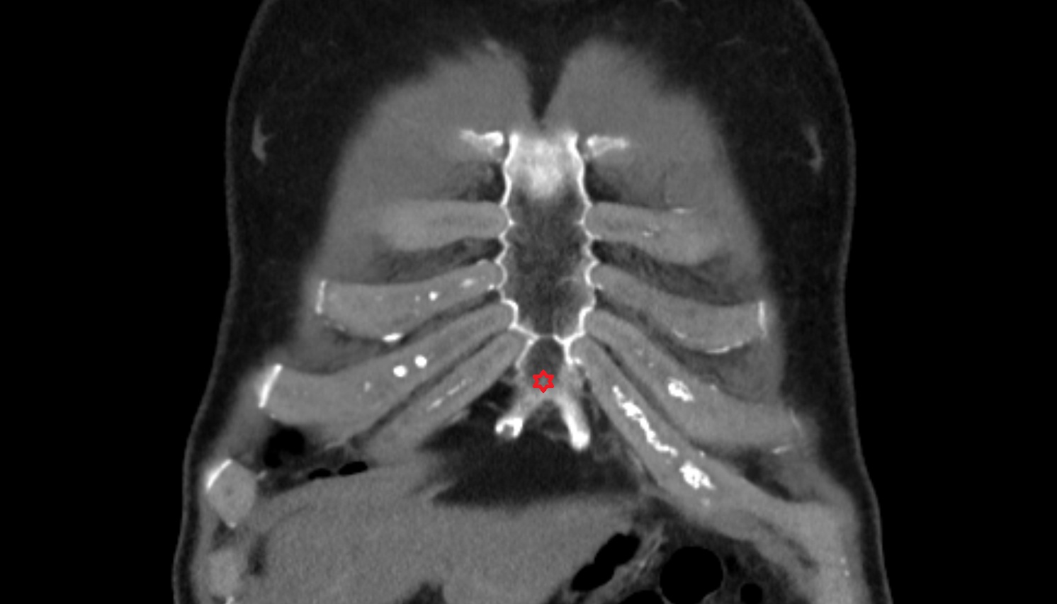 Xiphoid process of sternum CT coronal  image -img-00000-00000