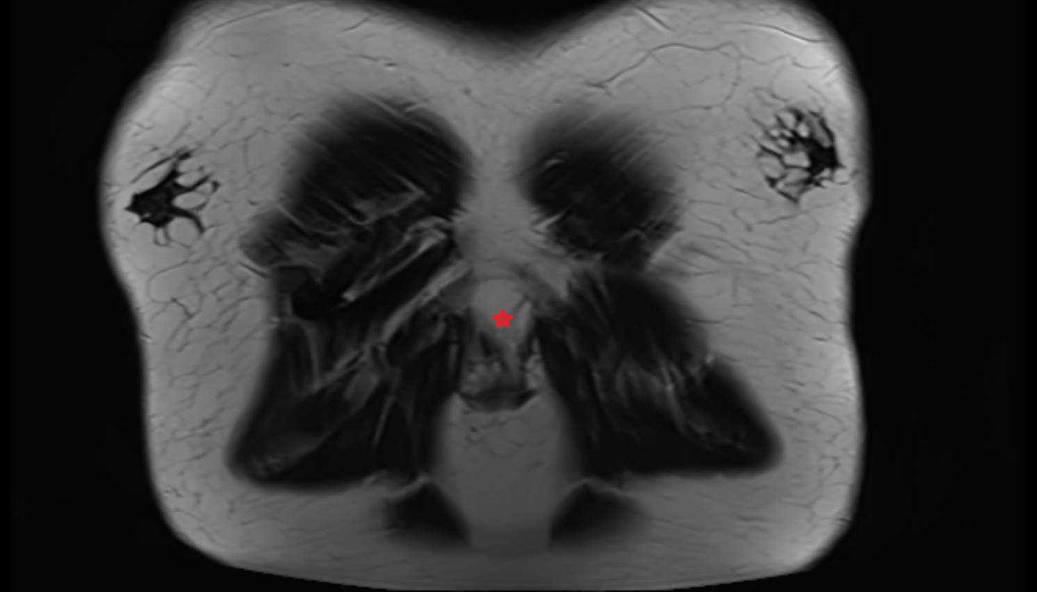 Xiphoid process of sternum MRI coronal  image -img-00000-00000
