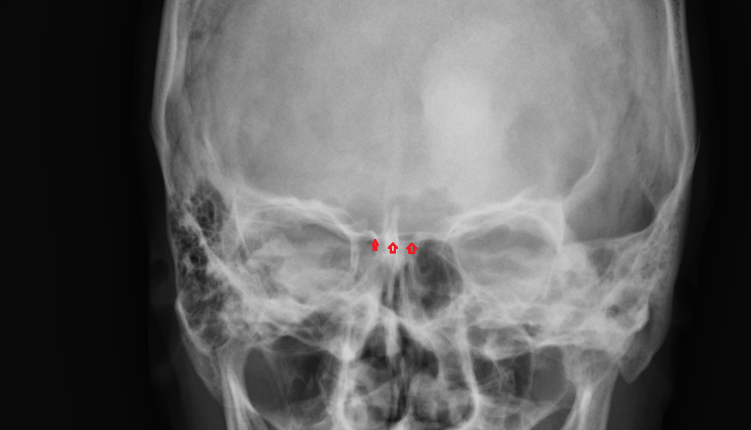 X ray Cribriform plate anatomy image -img-00000-00000