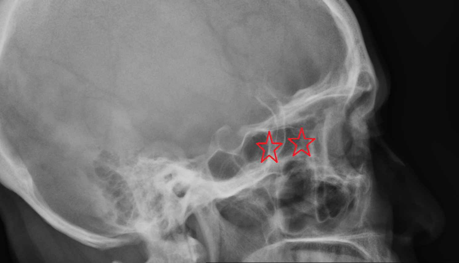 X ray  Ethmoid sinus  anatomy image -img-00000-00000