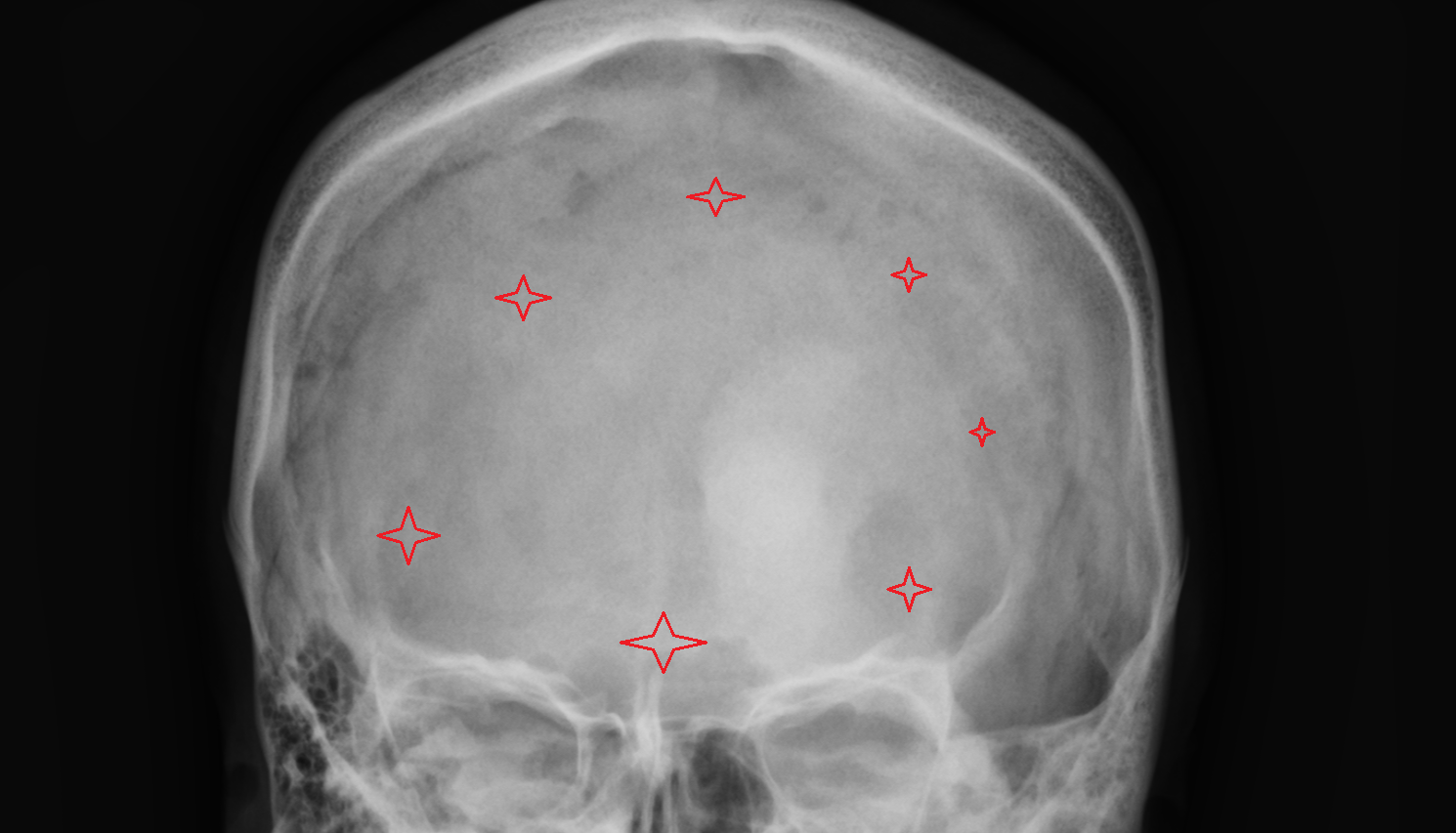 X ray Frontal bone anatomy image -img-00000-00000