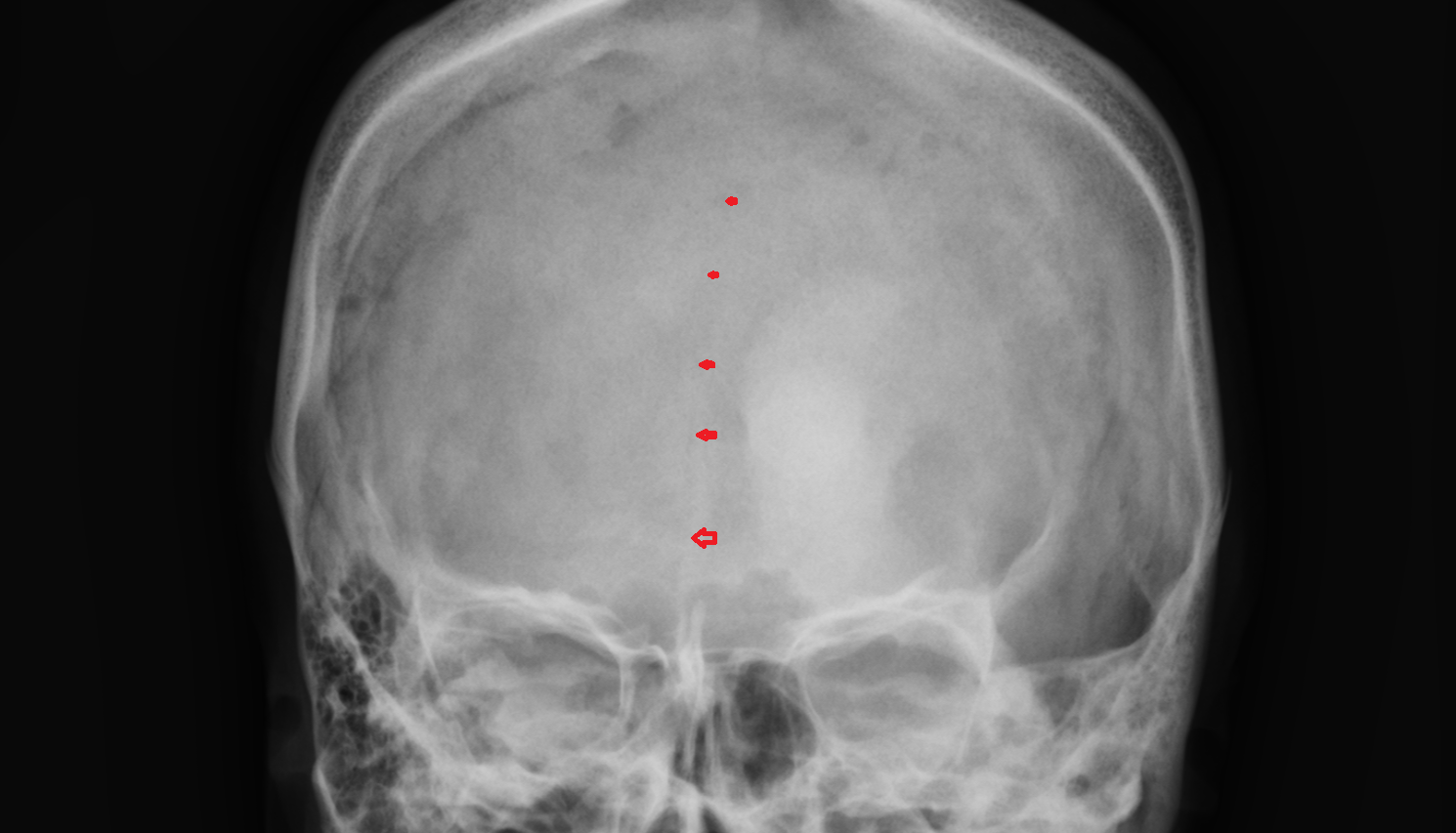 X rayFrontal suture anatomy image -img-00000-00000