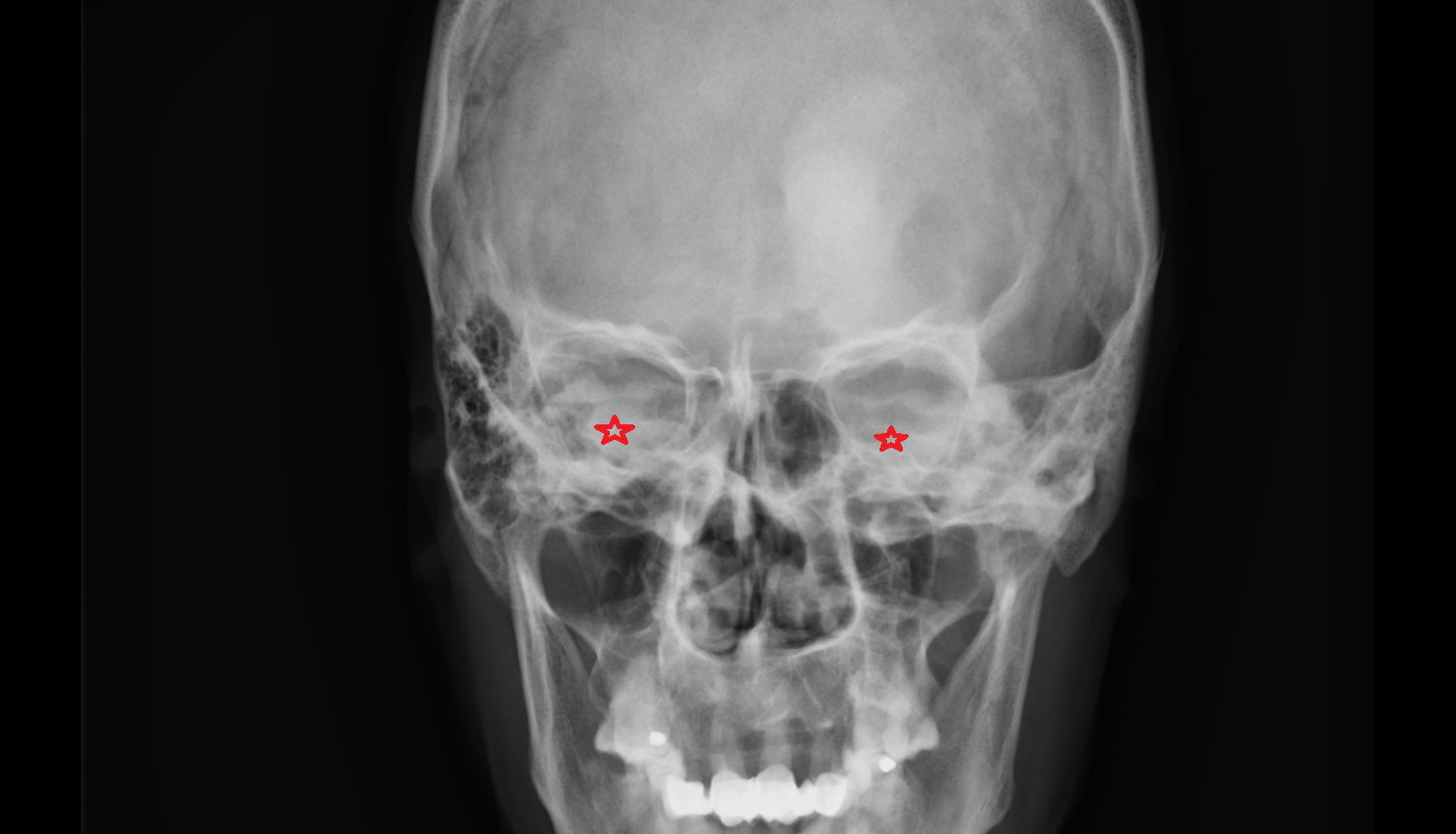 X rayGreater wing of sphenoid anatomy image -img-00000-00000