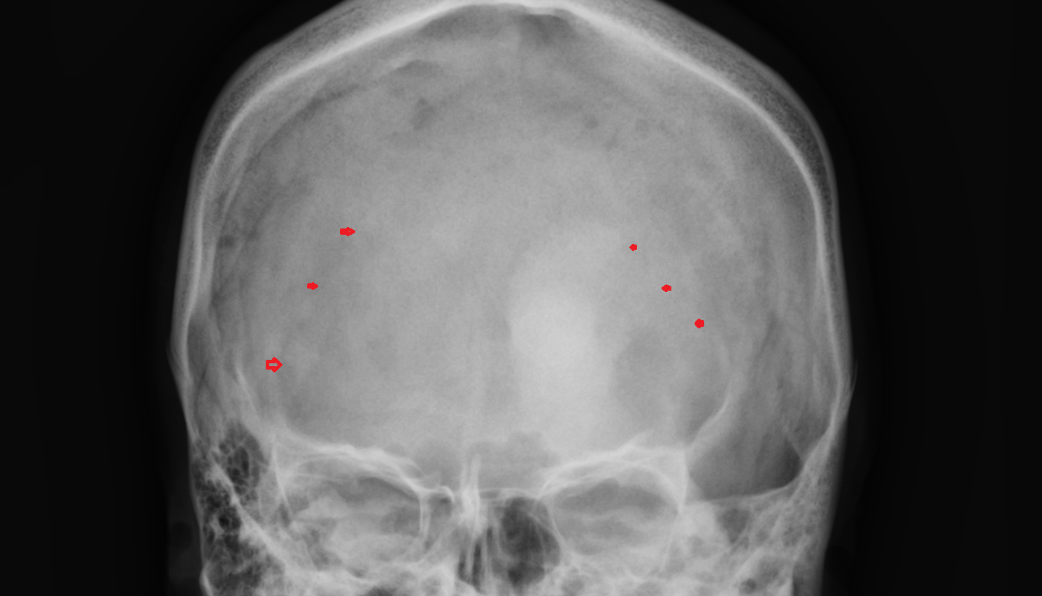 X ray Lambdoid Suture anatomy image -img-00000-00000