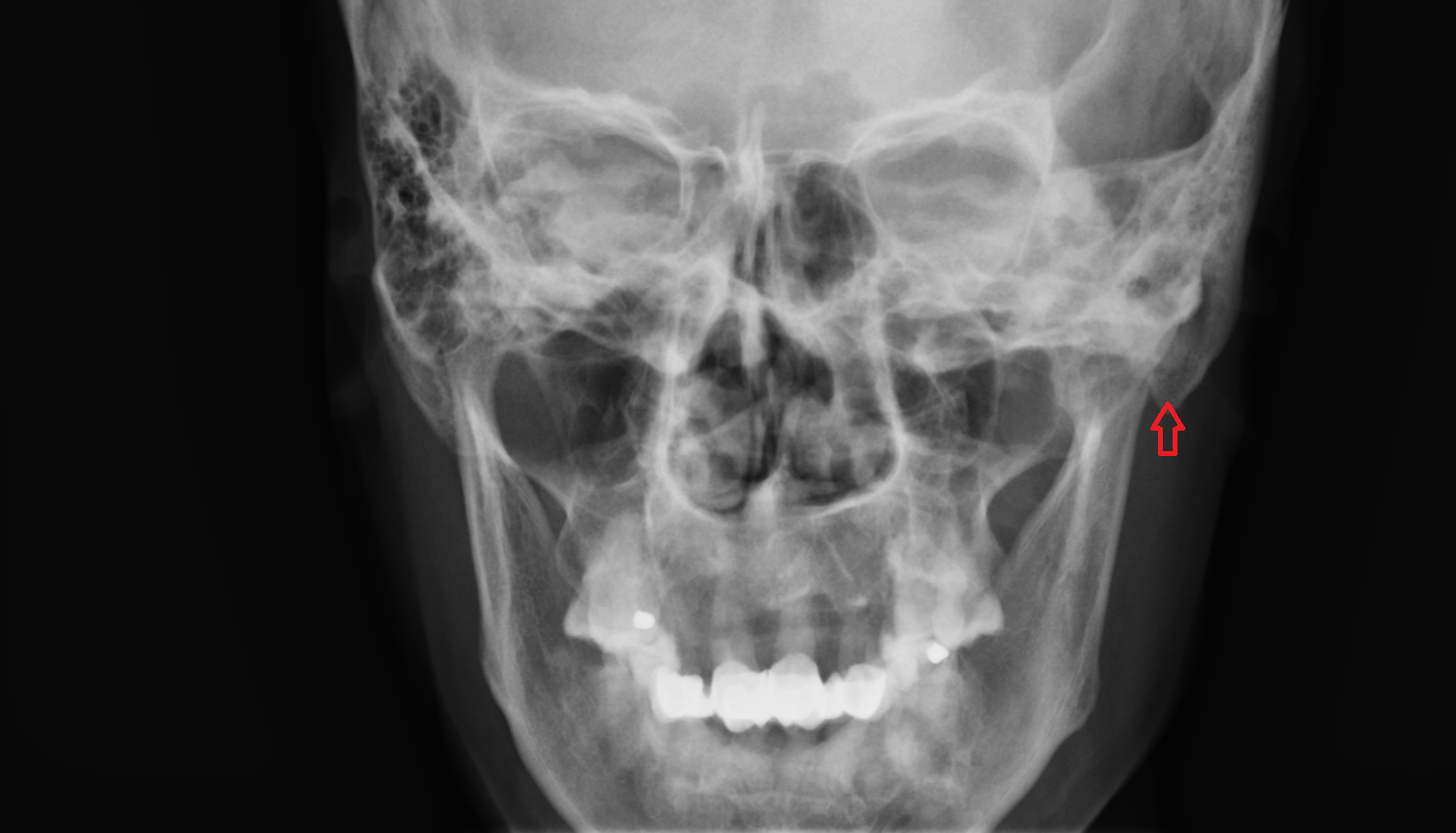 X rayMastoid process anatomy image -img-00000-00000
