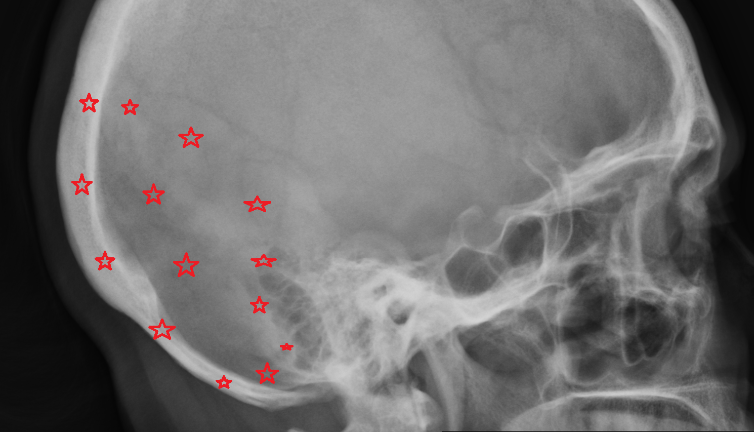 X ray Occipital bone anatomy image -img-00000-00000
