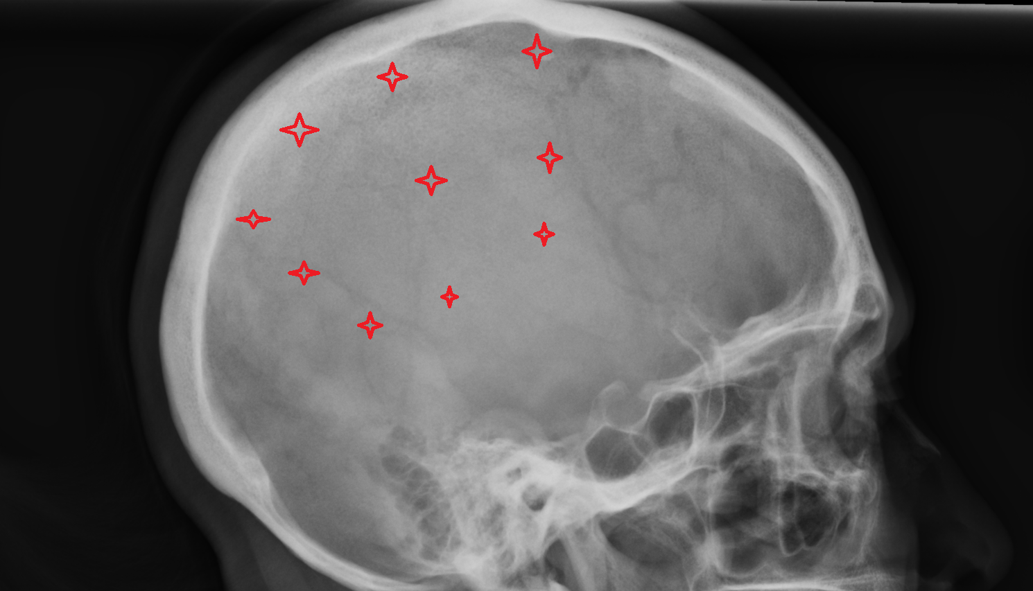 X ray Parietal bone anatomy image -img-00000-00000