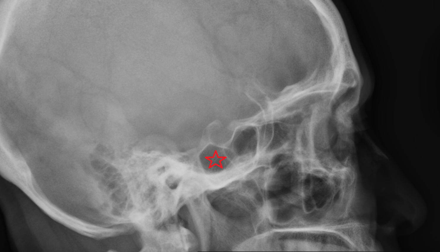X ray Sphenoidal sinus  anatomy image -img-00000-00000