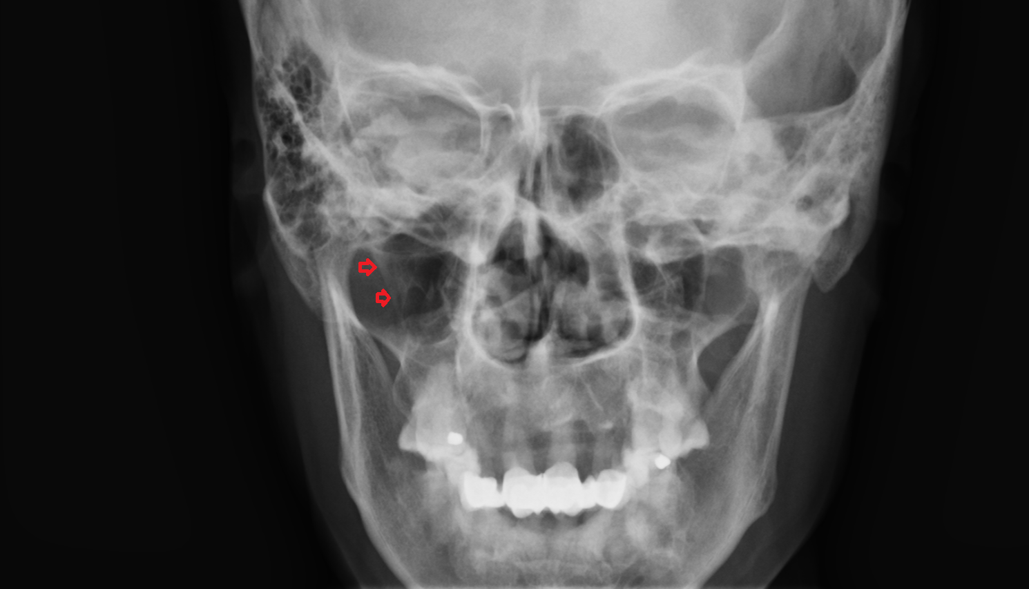 X ray Styloid process anatomy image -img-00000-00000