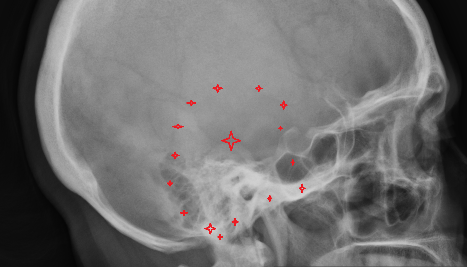 X ray Temporal bone anatomy image -img-00000-00000