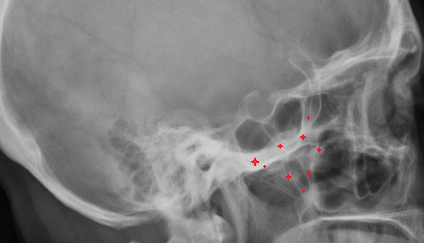 X ray Zygomatic bone anatomy image -img-00000-00000