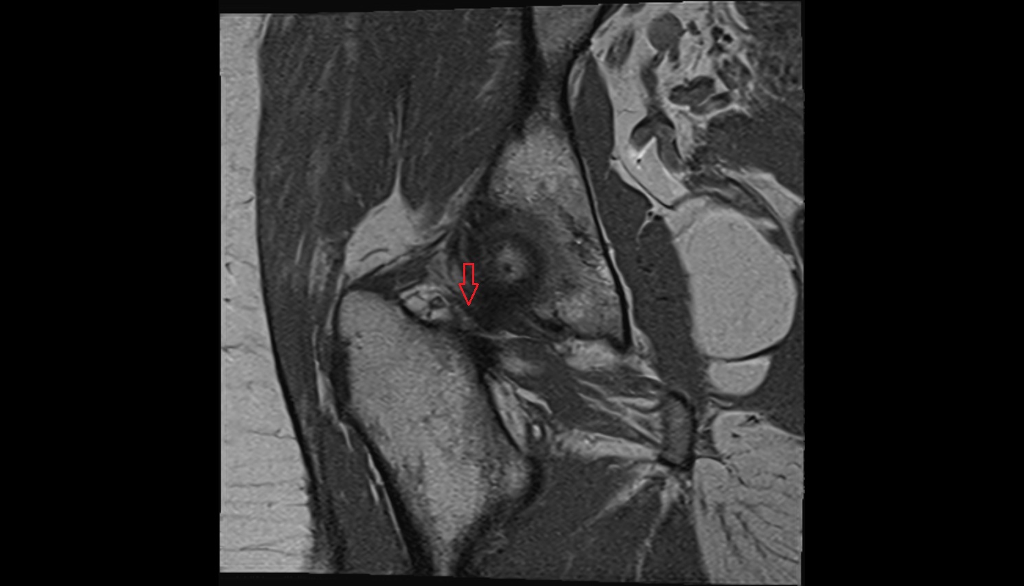 Zona orbicularis ligament  MRI coronal  anatomy image-img-00000-00000