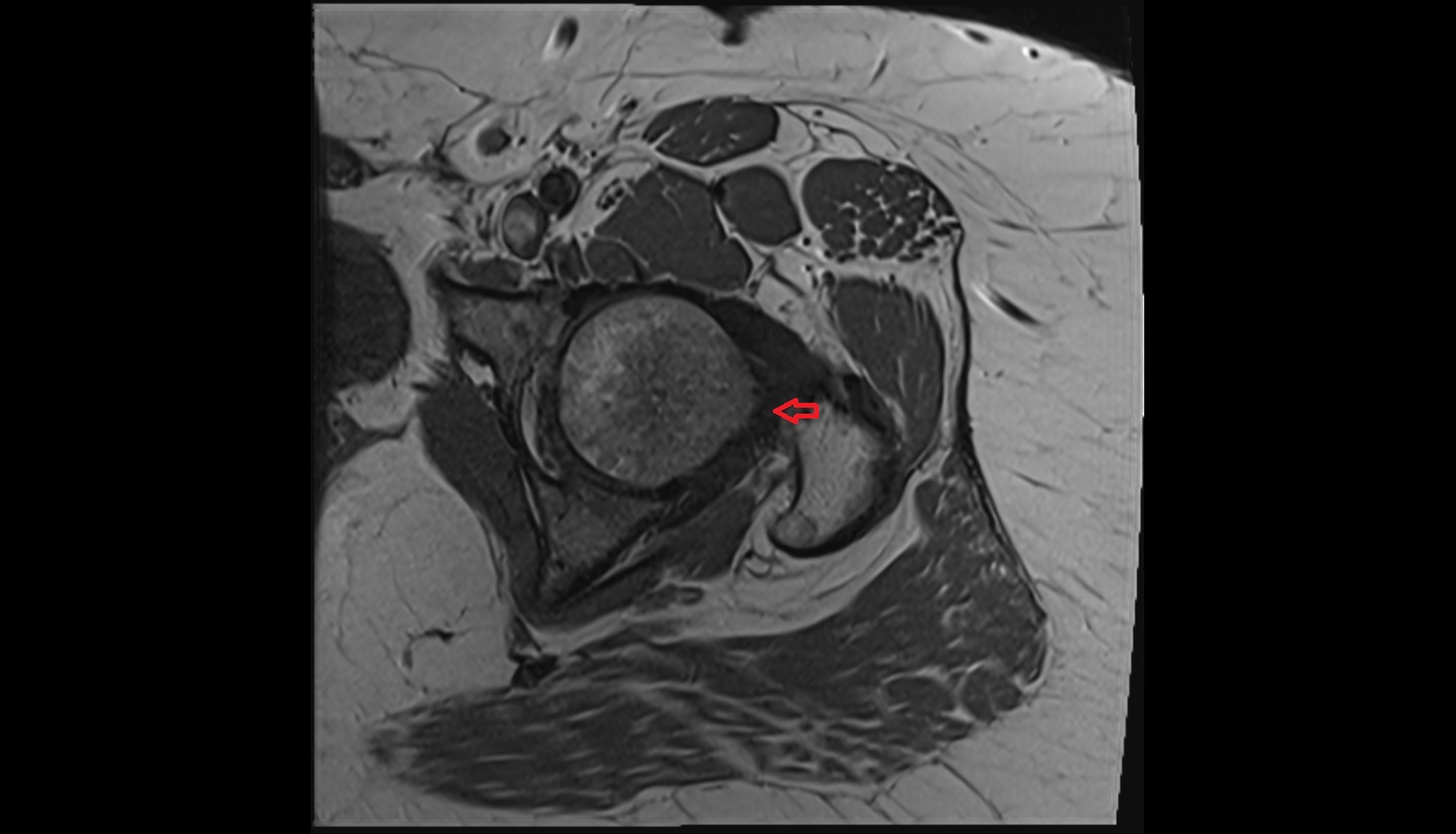 Zona orbicularis ligament  MRI coronal  anatomy image-img-00000-00000_00001