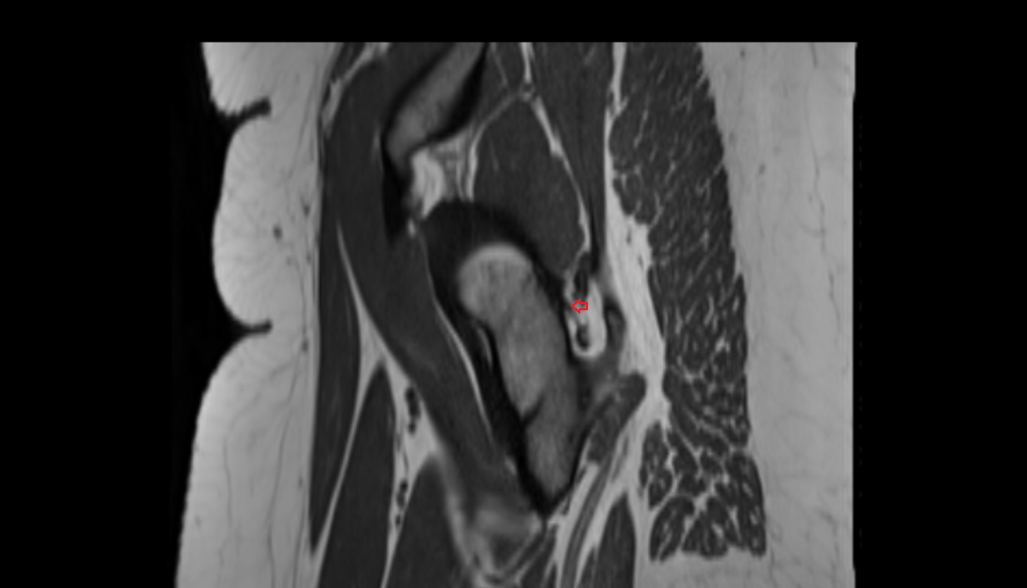 Zona orbicularis ligament  MRI coronal  anatomy image-img-00000-00000_00002