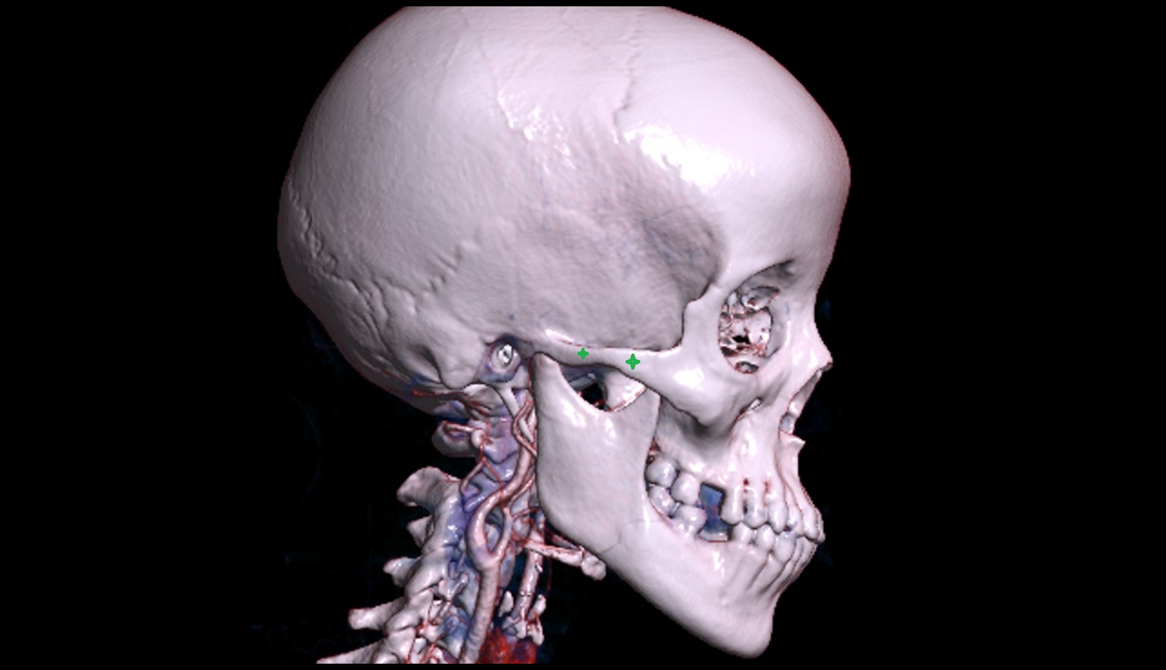 Zygomatic arch 3d