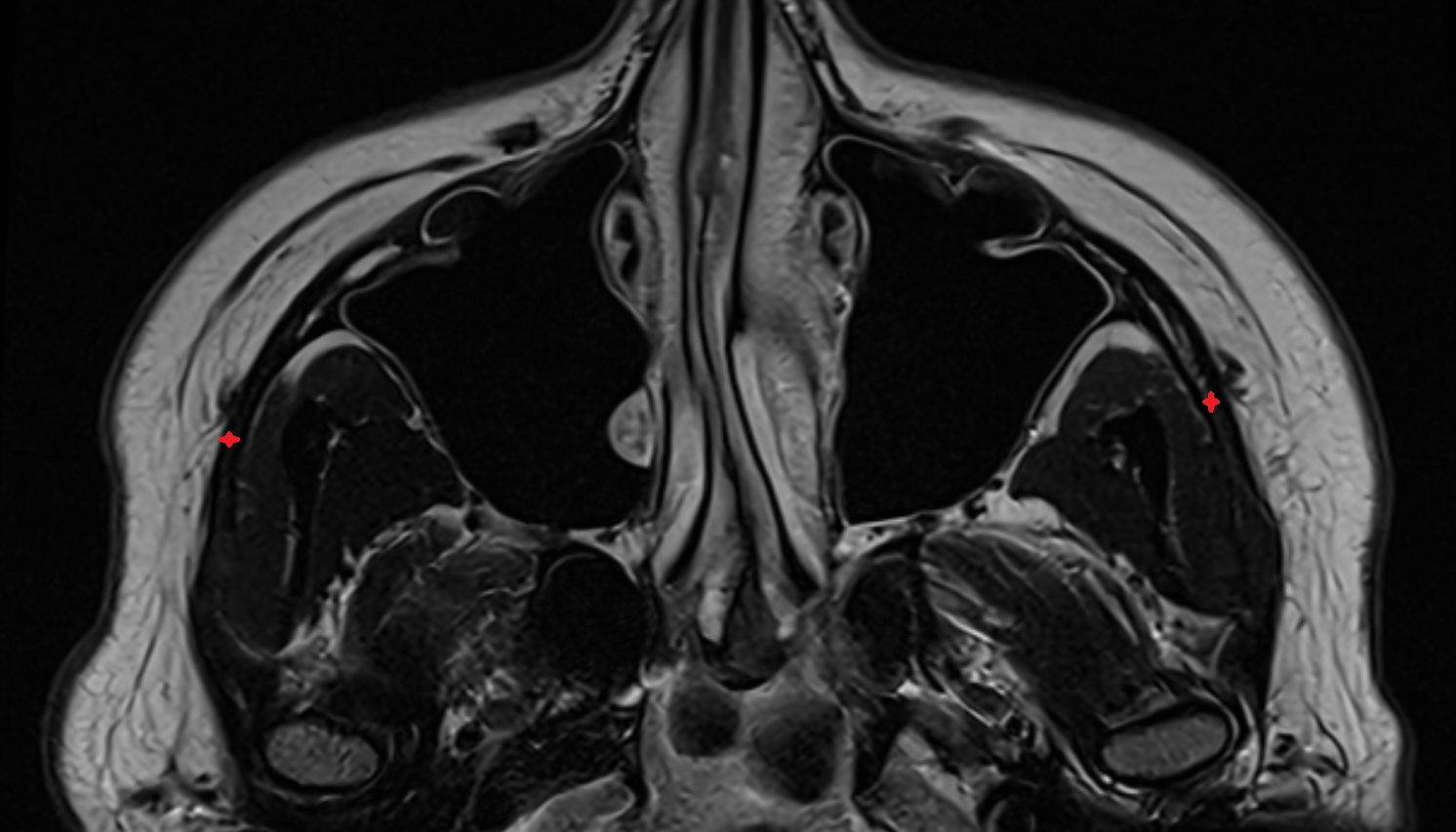Zygomatic arch  mri axial image -img-00000-00000