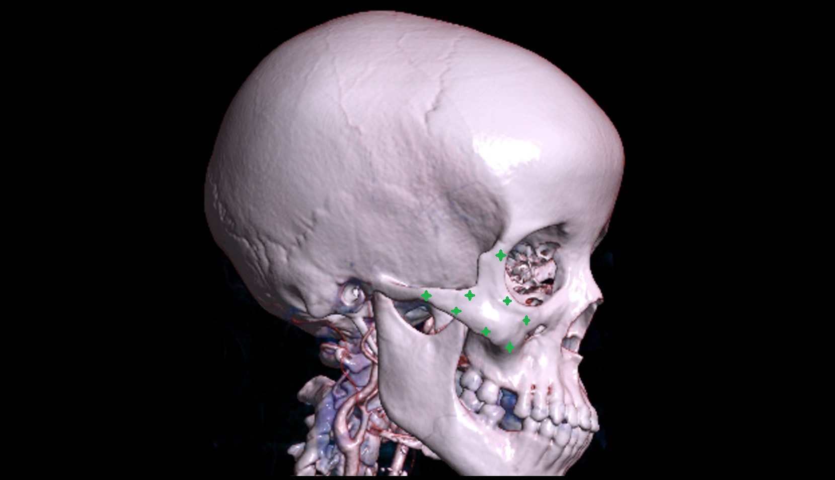 Zygomatic bone 3d