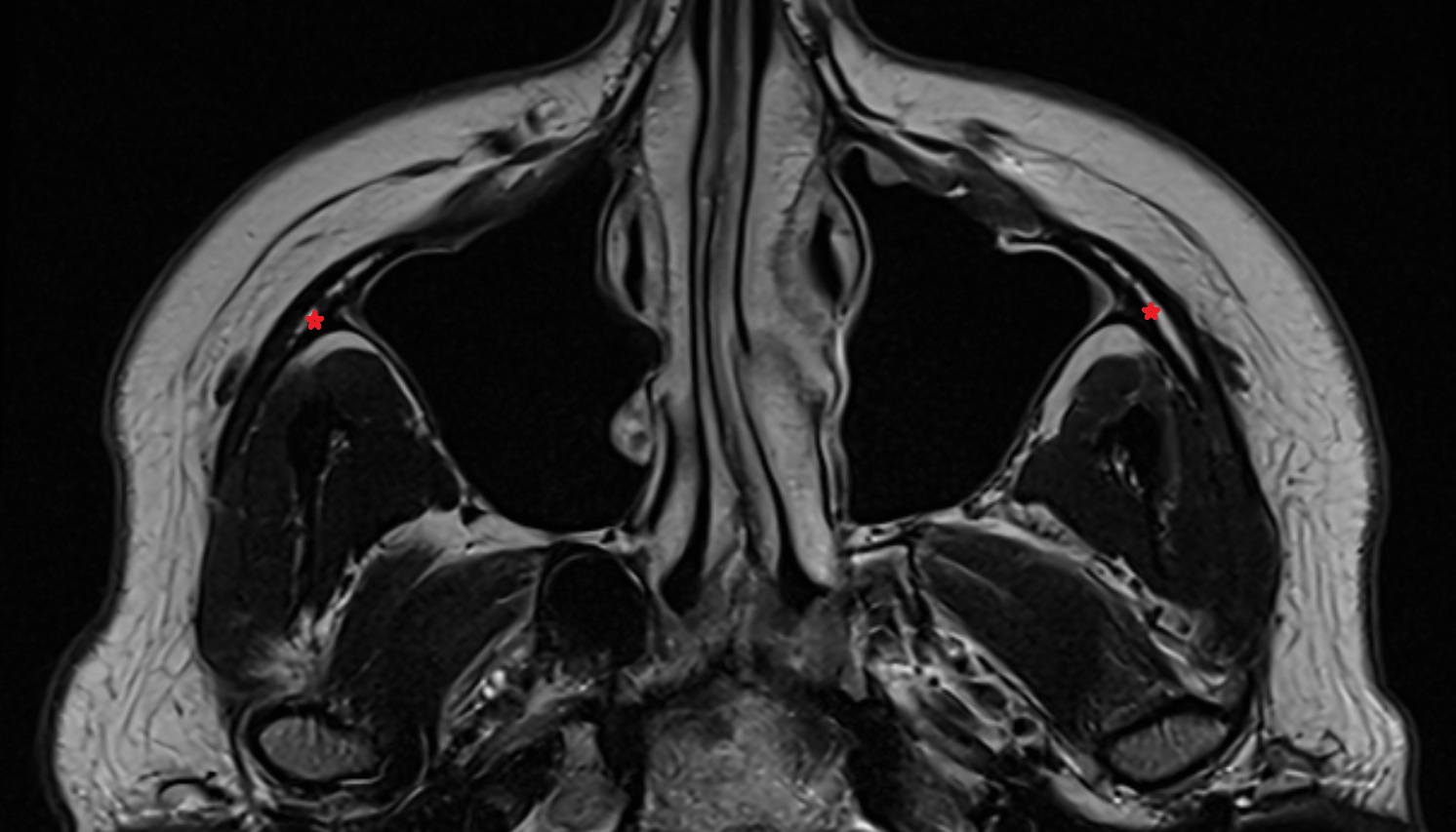 Zygomatic bone  mri axial image -img-00000-00000