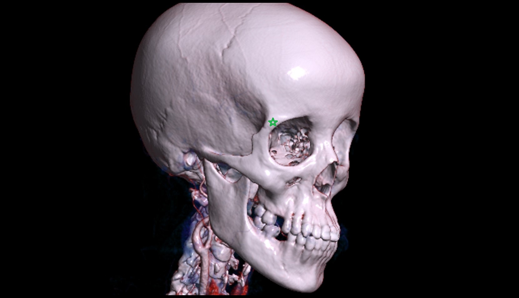Zygomatic process of frontal bone3d