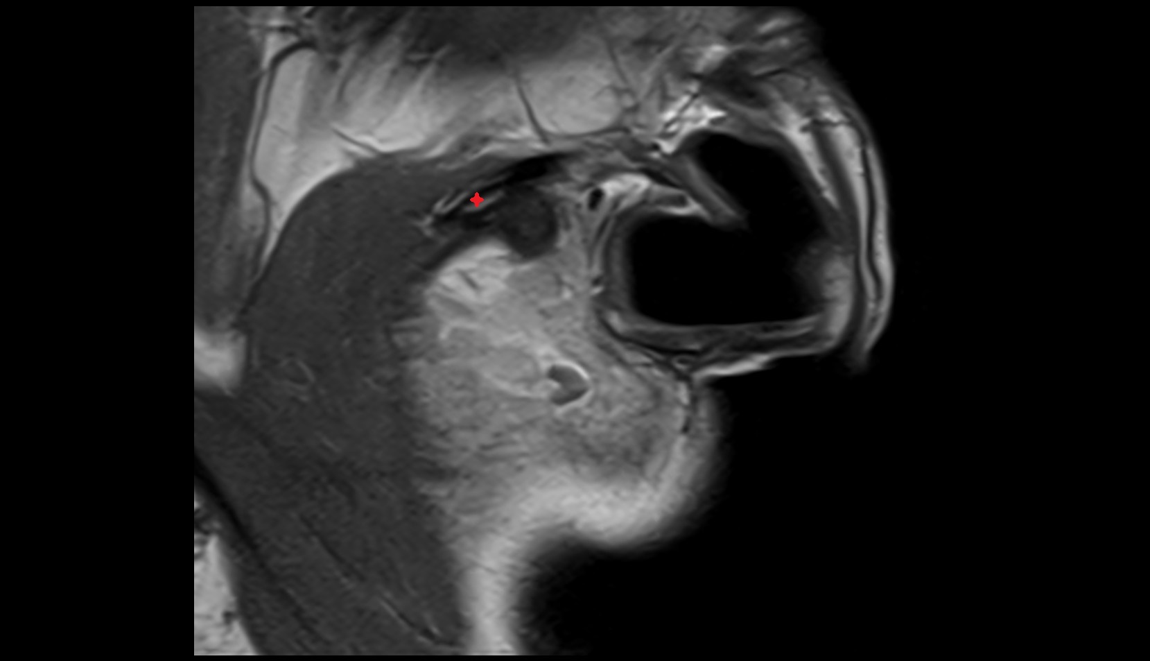 Zygomatic process of temporal bone mri