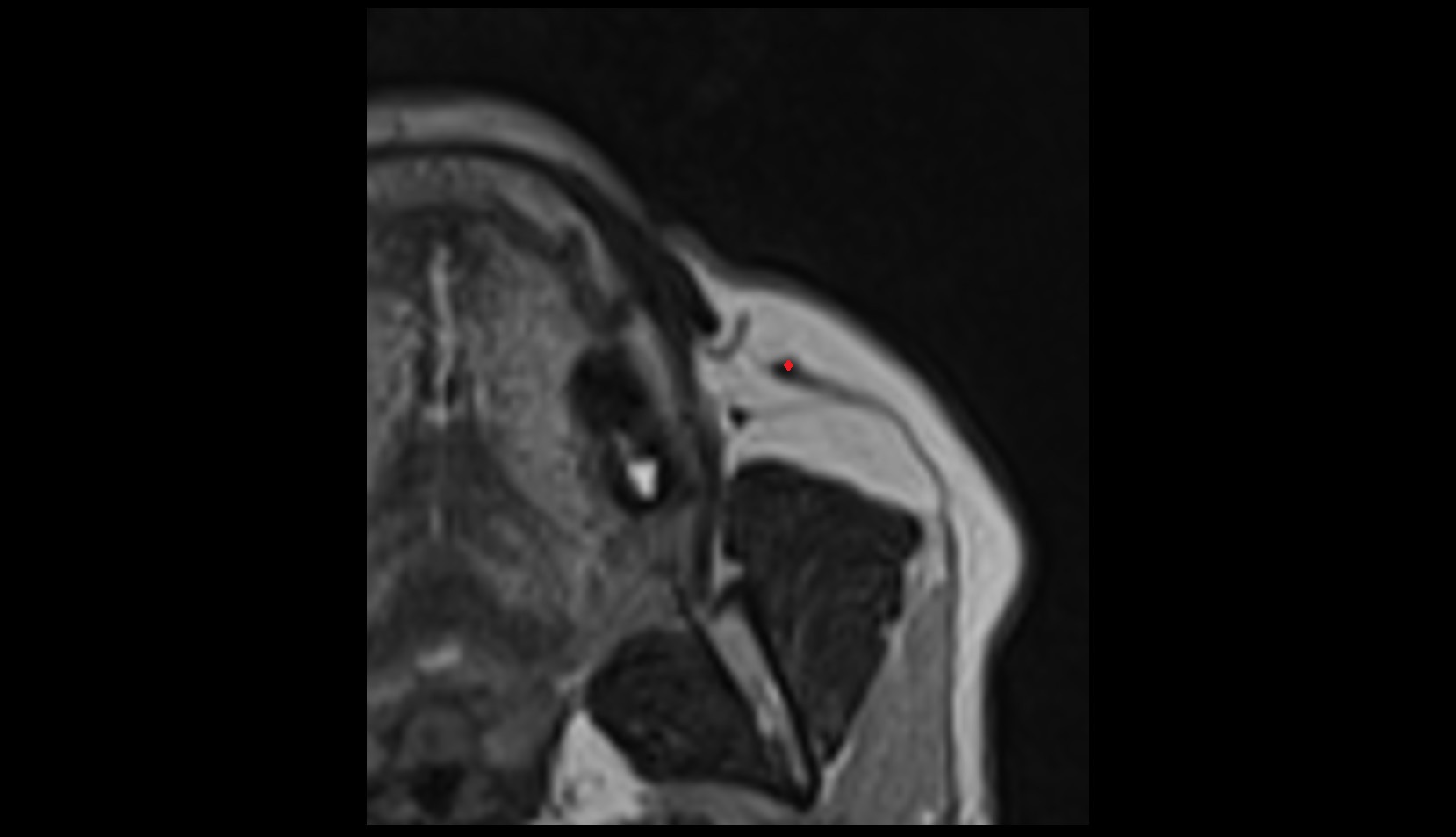 Zygomaticus major muscle