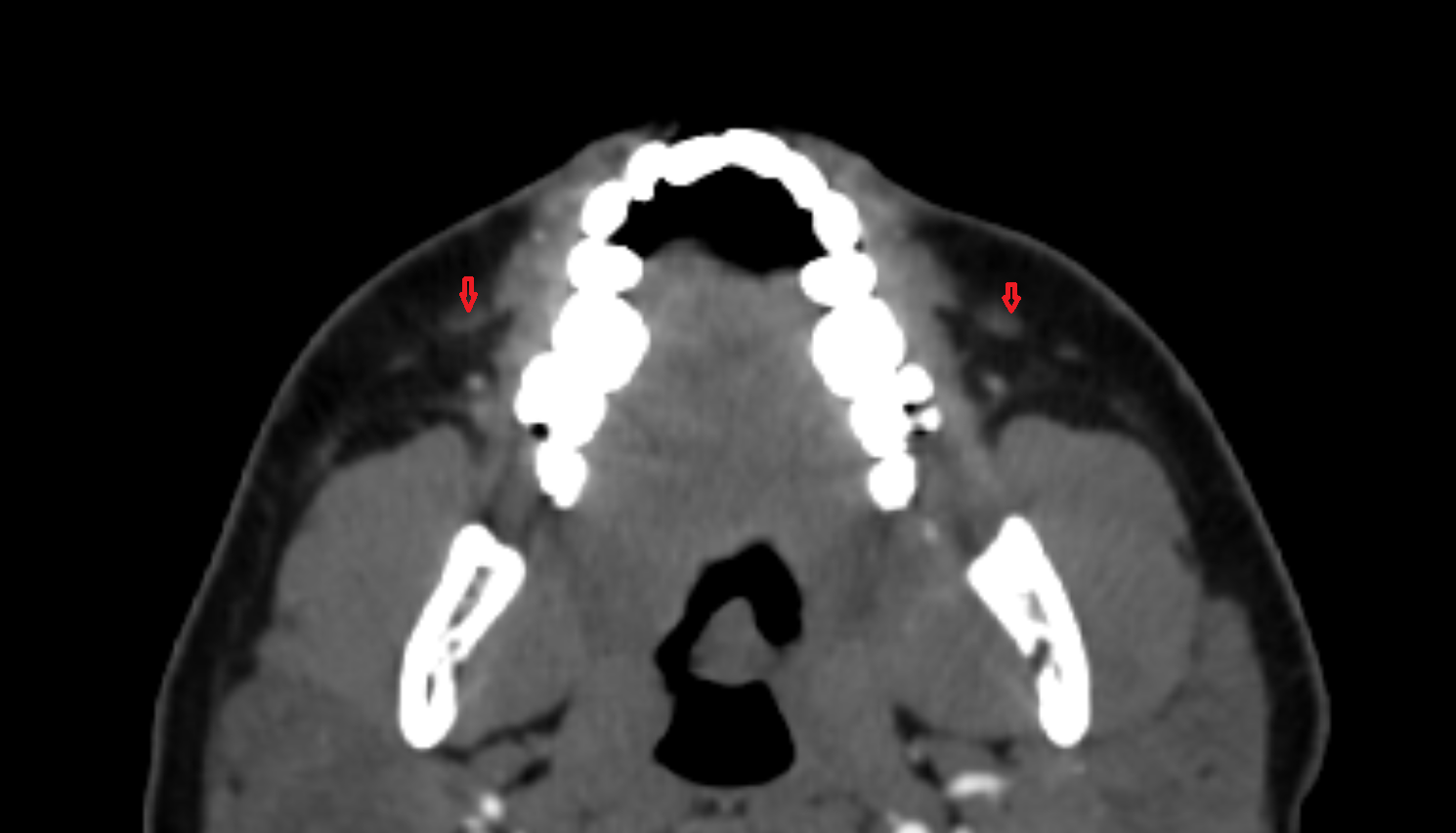 Zygomaticus minor muscle CT axial  image-img-00000-00000