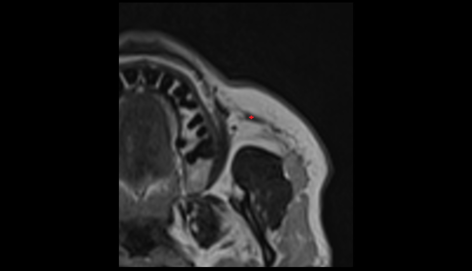 Zygomaticus minor muscle MRI axial image