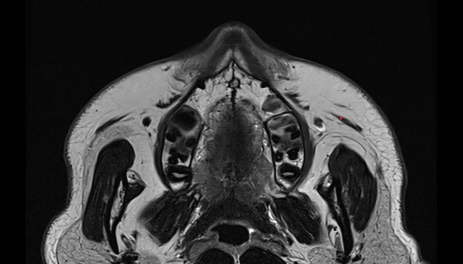 Zygomaticus minor muscle mri axial image -img-00000-00000